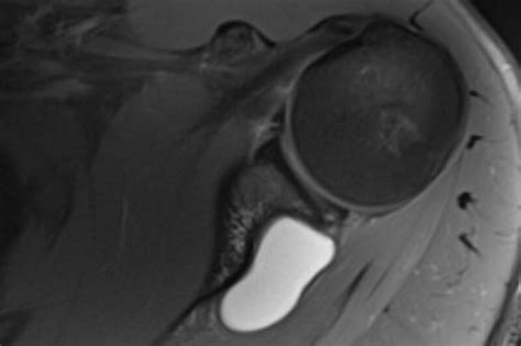 Latest Hip Subchondroplasty Research See More On Hip Subchondroplasty Research. . How long does it take for a paralabral cyst to develop in shoulder